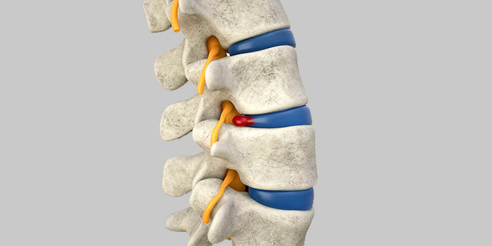 disc injury treatment and chiropractic conditions in the Financial District, Downtown San Francisco