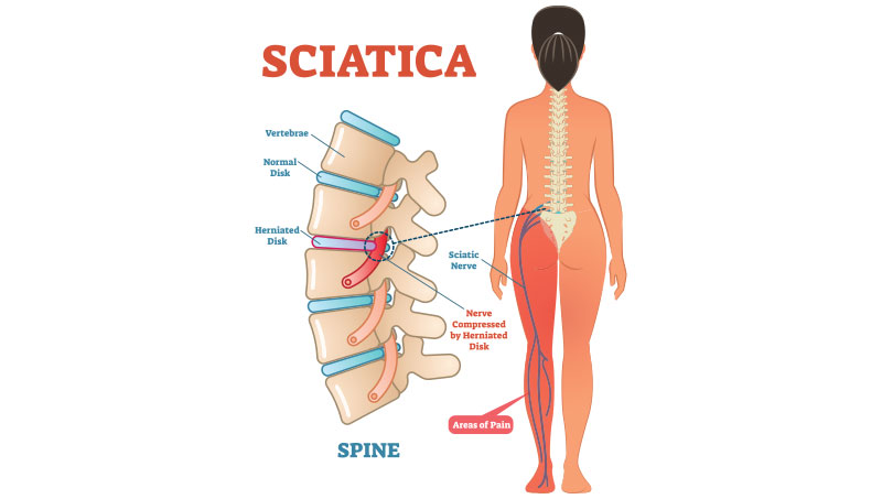 sciatica chiropractor in the Financial District, Downtown San Francisco